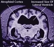 Damaged brain